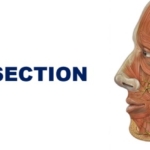 FLAP DISSECTION