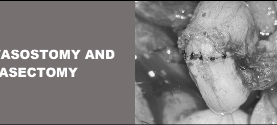 VASOVASOSTOMY AND  VASECTOMY